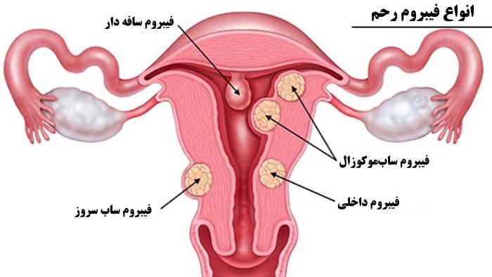 فیبر رحم