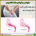 داروی چسبندگی رحم - تصویر 5