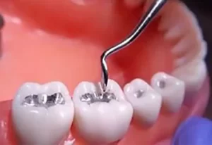 بازسازی دندان خراب و سوراخ شده روغنهای طب اسلامی