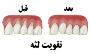 تقویت لثه کاربرد پودر دندان