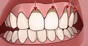 آبسه دندان روغتهای طب اسلامی