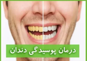 درمان پوسیدگی دندان با روغن های طب اسلامی